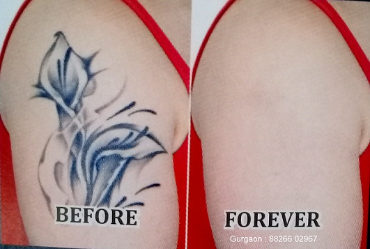 tattoo removal in gurgaon, laser tatoo removal in gurgaon